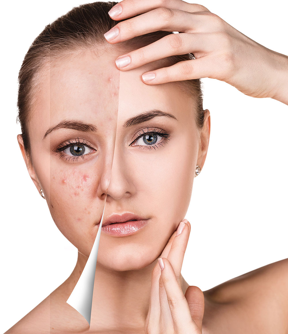 Professional facial treatment for acne, oily skin and rosacea-prone complexions.