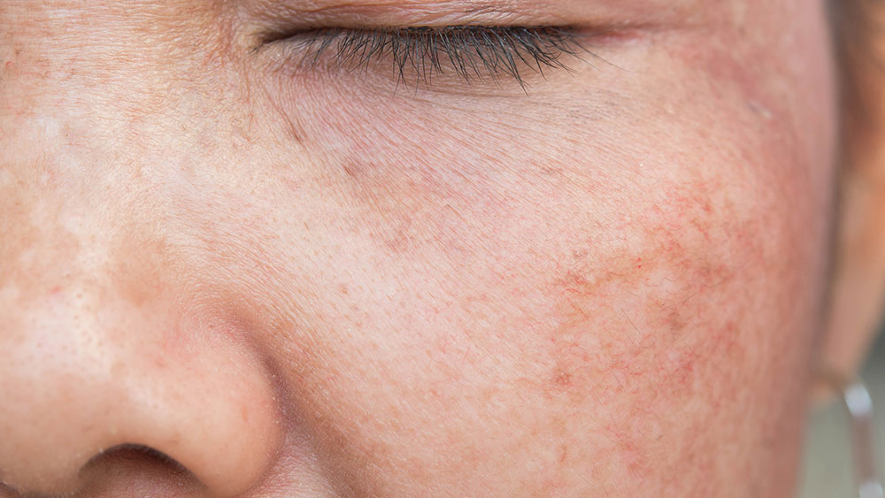 Advanced treatment for pigmentation and melasma to achieve a more even skin tone.