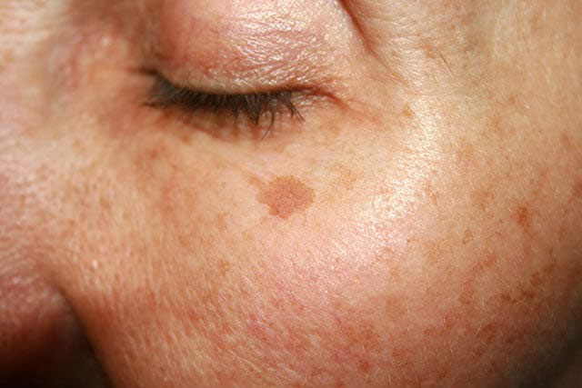 An image of treatment of pigmented lesions, such as sun-damaged skin and age spots.