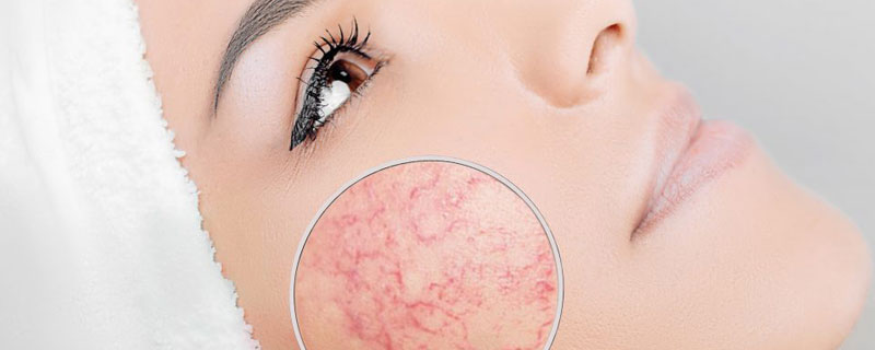 Advanced thread vein removal treatment to reduce visible facial and leg veins.