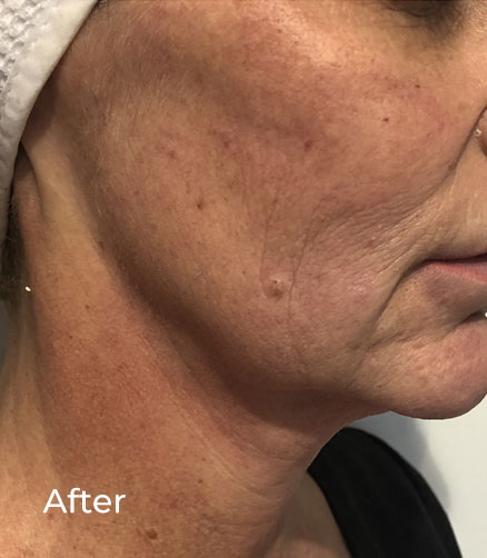 CFU-ELIFE HIFU Face & Neck Lifting additional image