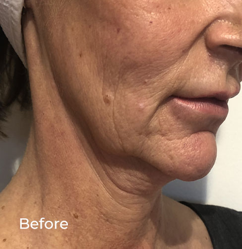 CFU-ELIFE HIFU Face & Neck Lifting additional image