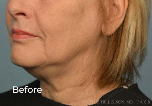 RF & Skin Tightening additional image