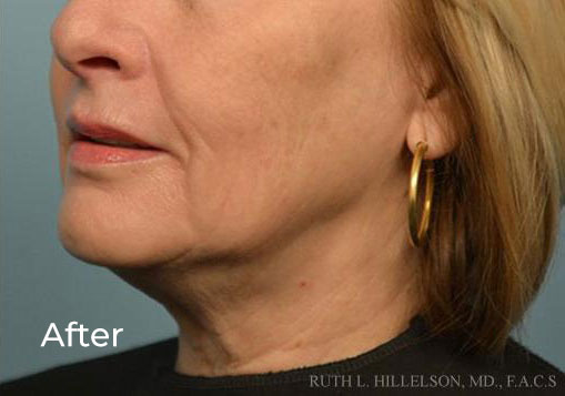 RF & Skin Tightening additional image