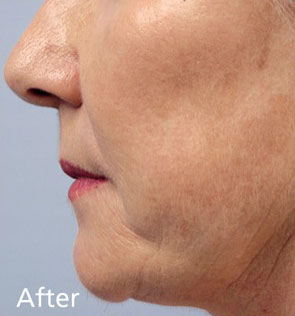 Fractora additional image