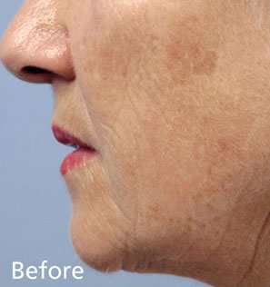 Fractora additional image