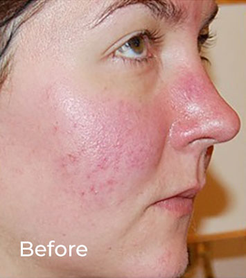 Danne Rosacea Treatment additional image