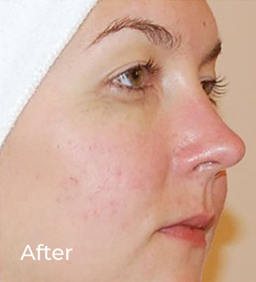 Danne Rosacea Treatment additional image