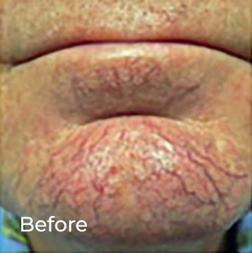 Veinwave Thread Vein Removal additional image