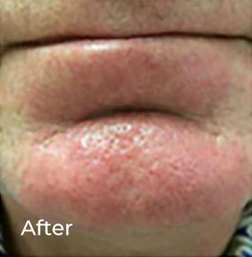 Veinwave Thread Vein Removal additional image
