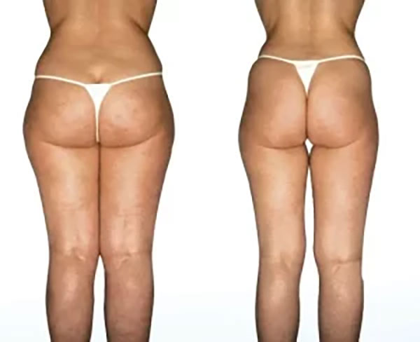 Endermologie additional image