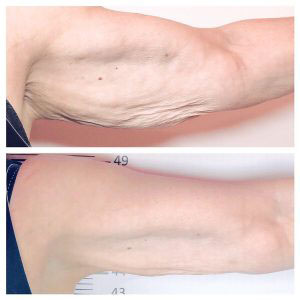Endermologie additional image